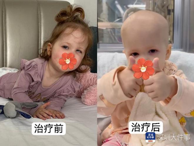 基因治疗“逆天改命”！瑞典罕见遗传病患儿万里赴粤重获新生(图2)