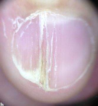孩子指甲软薄易断、月牙少、长白点、竖纹是显示身体有健康风险吗？(图11)