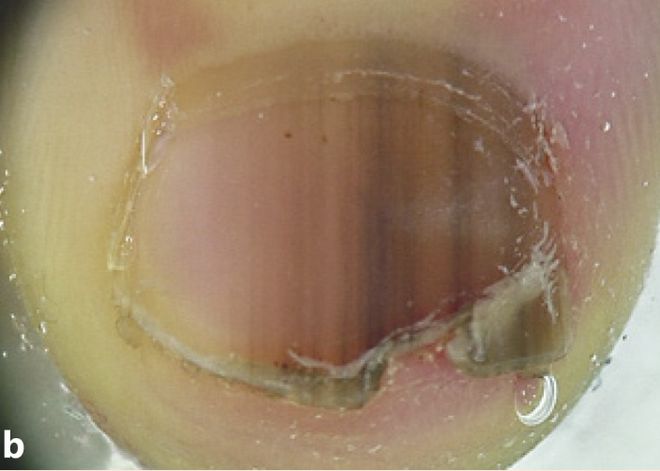 孩子指甲软薄易断、月牙少、长白点、竖纹是显示身体有健康风险吗？(图8)