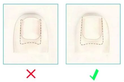 孩子指甲软薄易断、月牙少、长白点、竖纹是显示身体有健康风险吗？(图13)