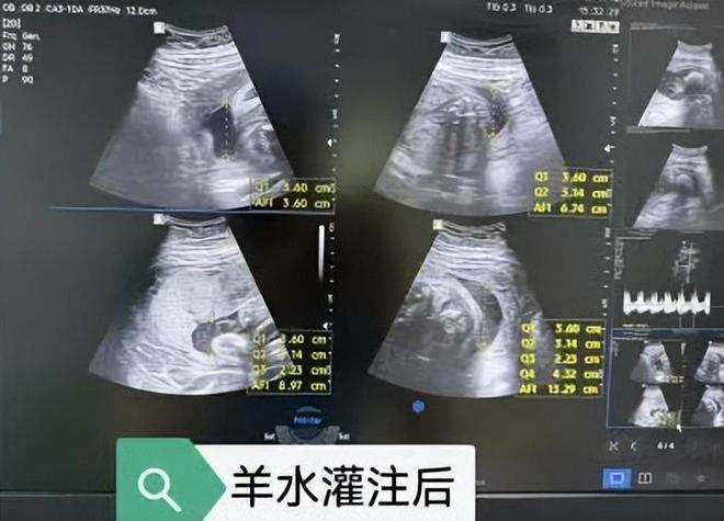【邯郸首例】邯郸市第一医院成功实施胎儿羊水灌注术(图3)